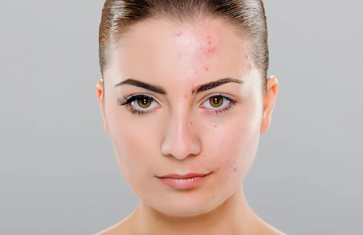 Best Acne Serum in Pakistan