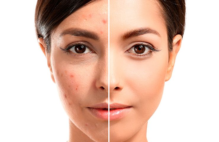 best anti-acne gel in Pakistan